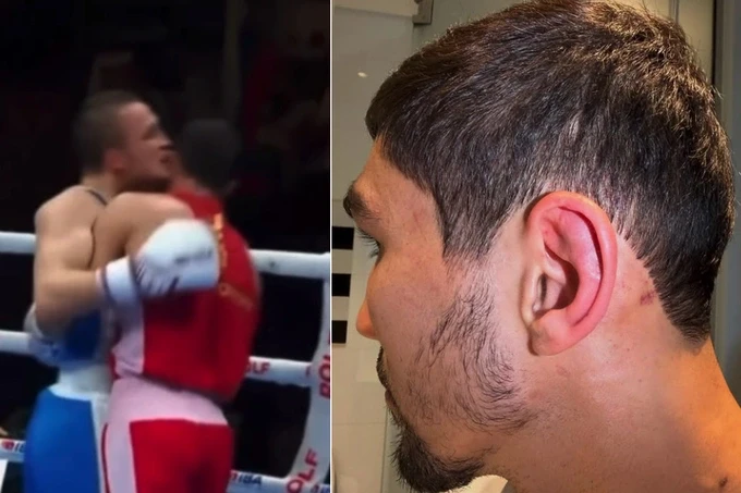 "This is not dog fighting." Uzbekistan's coach on how a Russian boxer bit an Uzbek in the World Championship final.