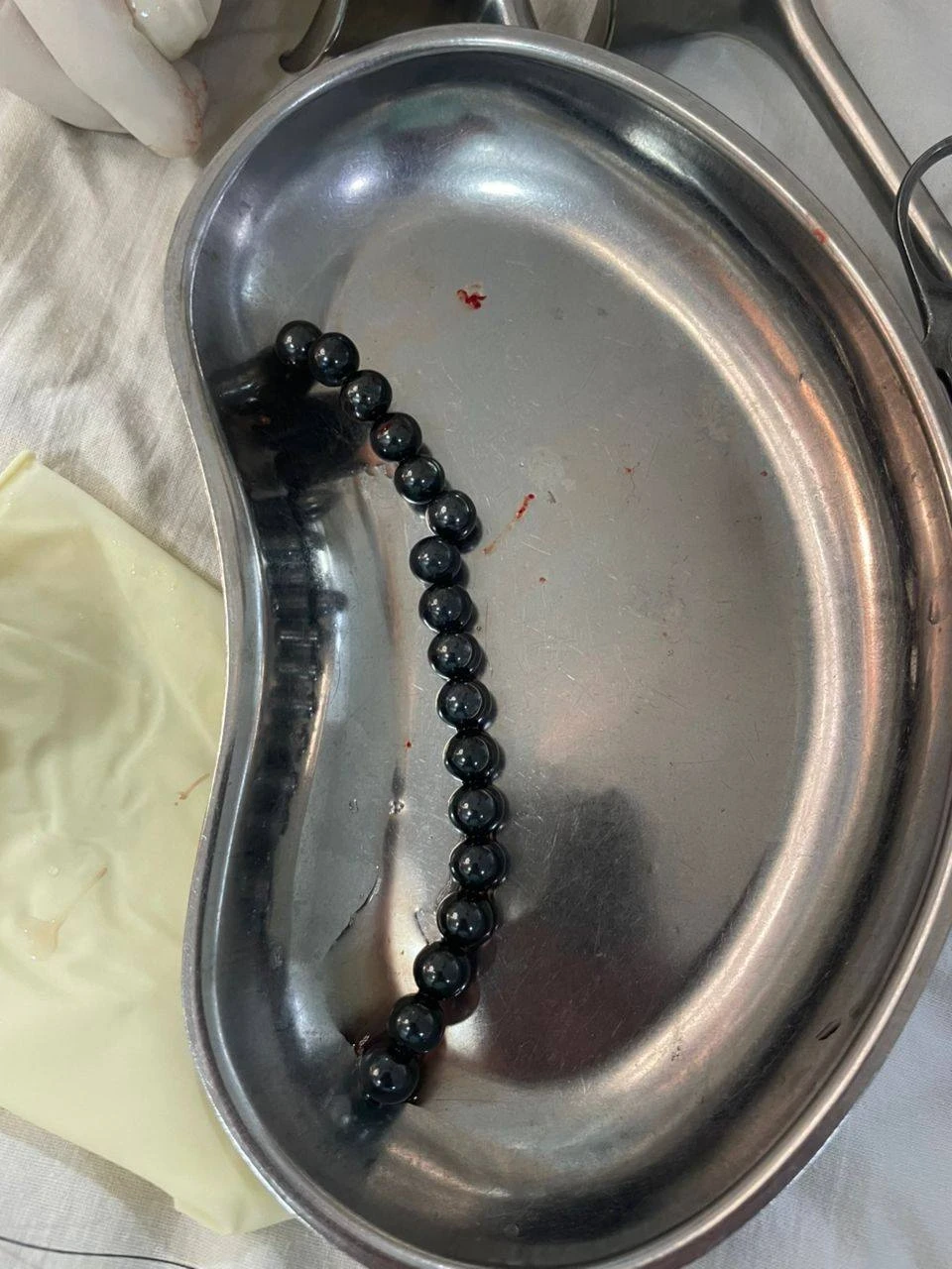 Ошто эки жаштагы бала 17 жутулган магнитти ш急 түрдө алып салды