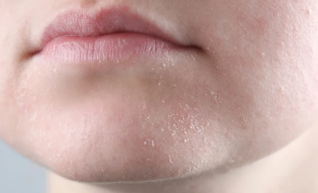 Доктор теринин кургактыгы менен байланышкан оорулар тууралуу айтып берди