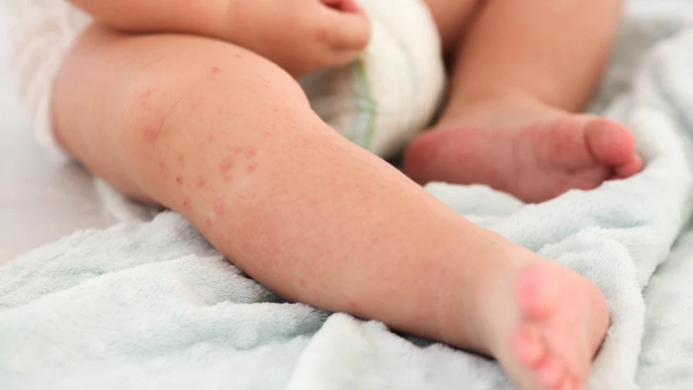 WHO and UNICEF: Measles Incidence in Europe and Central Asia Decreased by 75%