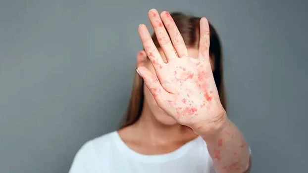 In Kazakhstan, unvaccinated children are temporarily removed from schools and kindergartens upon detection of measles.