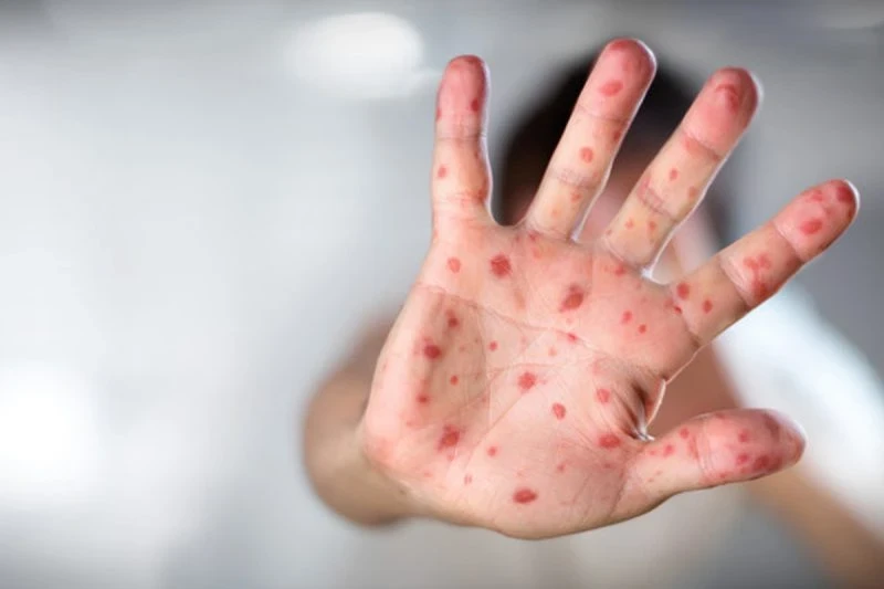 Doctors in Kazakhstan Sound the Alarm: Measles is Turning into Pneumonia and Progressing to Brain Inflammation