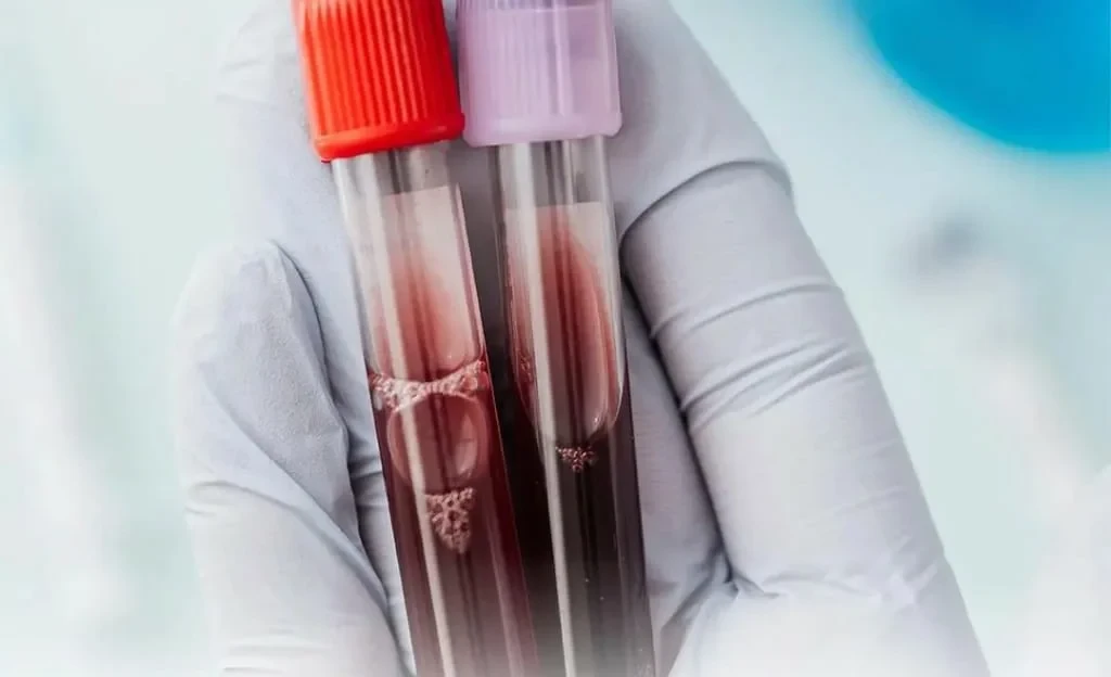 Бишкектик дарыгерлер анемияны кантип алдын алууга болорун айтып беришти